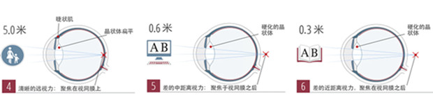 你是老花眼吗?老花眼症状、形成和治疗